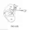 Fig. 85 - Methods of fusing a sacroiliac joint with an additively manufactured sacroiliac joint implant