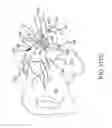 Fig. 91 - Methods of fusing a sacroiliac joint with an additively manufactured sacroiliac joint implant