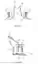 Fig. 02 - Total artificial spino-laminar prosthetic replacement
