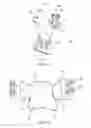 Fig. 03 - Total artificial spino-laminar prosthetic replacement