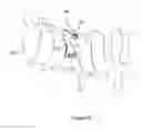 Fig. 04 - Total artificial spino-laminar prosthetic replacement