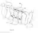 Fig. 11 - Total artificial spino-laminar prosthetic replacement