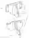 Fig. 17 - Total artificial spino-laminar prosthetic replacement