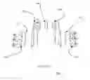 Fig. 42 - Total artificial spino-laminar prosthetic replacement