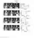 Fig. 03 - Method of treating medulloblastoma