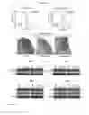 Fig. 04 - Method of treating medulloblastoma