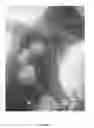 Fig. 03 - Kit for treating sepsis and/or any systemic (SIRS) or damaging cellular hyperinflammation