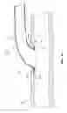 Fig. 11 - Methods and devices for percutaneous implantation of arterio-venous grafts
