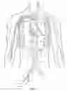 Fig. 12 - Methods and devices for percutaneous implantation of arterio-venous grafts