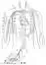 Fig. 13 - Methods and devices for percutaneous implantation of arterio-venous grafts