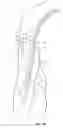 Fig. 16 - Methods and devices for percutaneous implantation of arterio-venous grafts