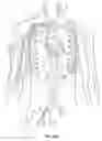 Fig. 17 - Methods and devices for percutaneous implantation of arterio-venous grafts
