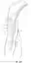 Fig. 20 - Methods and devices for percutaneous implantation of arterio-venous grafts