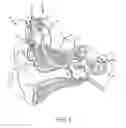 Fig. 02 - Implantable auditory prosthesis having isolated components