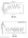 Fig. 03 - Methods and systems for controlling blood pressure by controlling atrial pressure