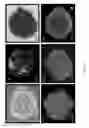 Fig. 07 - Methods for treating a brain tissue damage by cultured adult pluripotent olfactory stem cells