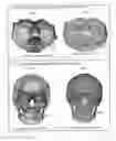 Fig. 37 - PRODUCING A THREE-DIMENSIONAL MODEL OF AN IMPLANT