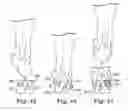 Fig. 32 - Energy return orthotic systems