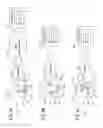 Fig. 11 - Electromyography with prosthetic or orthotic devices