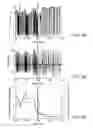 Fig. 08 - IDENTIFICATION OF DYNAMIC HYPERINFLATION USING A COMBINATION OF EXPIRATORY FLOW AND RESPIRATORY CARBON DIOXIDE SIGNALS