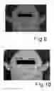Fig. 06 - APPARATUS AND METHOD FOR DETECTION, QUANTIFICATION AND CLASSIFICATION OF EPIDERMAL LESIONS
