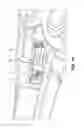Fig. 13 - Tissue removal system