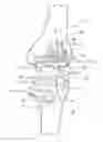 Fig. 01 - Low profile patient specific cutting blocks for a knee joint