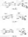 Fig. 09 - Bone intramedullary fixation scaffold