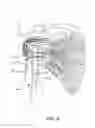 Fig. 08 - Humeral nail having a bracket