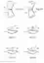 Fig. 07 - DEVICES, SYSTEMS, AND METHODS FOR RE-ALIGNMENT OF BONE