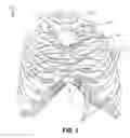 Fig. 02 - Adjustable rib and sternal implant