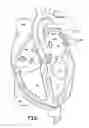 Fig. 06 - Selective stiffening catheter