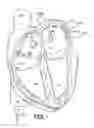 Fig. 07 - Selective stiffening catheter