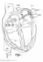 Fig. 08 - Selective stiffening catheter
