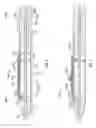 Fig. 04 - Intraocular lens inserter