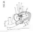 Fig. 07 - Transcatheter atrio-ventricular valve prosthesis