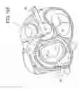 Fig. 22 - Transcatheter atrio-ventricular valve prosthesis