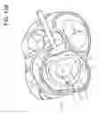 Fig. 28 - Transcatheter atrio-ventricular valve prosthesis
