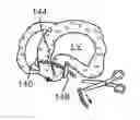 Fig. 01 - Location, time, and/or pressure determining devices, systems, and methods for deployment of lesion-excluding heart implants for treatment of cardiac heart failure and other disease states