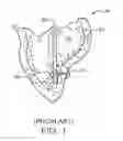 Fig. 02 - Location, time, and/or pressure determining devices, systems, and methods for deployment of lesion-excluding heart implants for treatment of cardiac heart failure and other disease states