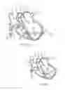 Fig. 06 - Location, time, and/or pressure determining devices, systems, and methods for deployment of lesion-excluding heart implants for treatment of cardiac heart failure and other disease states