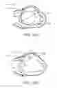 Fig. 16 - Location, time, and/or pressure determining devices, systems, and methods for deployment of lesion-excluding heart implants for treatment of cardiac heart failure and other disease states