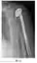 Fig. 03 - Adjustable orthopedic connections