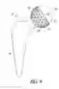 Fig. 11 - Adjustable orthopedic connections