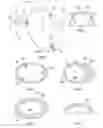 Fig. 03 - ARTICULAR SURFACE REPAIR
