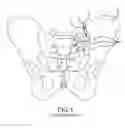 Fig. 02 - Methods of fusing a sacroiliac joint with a fluted screw delivered across the sacroiliac joint