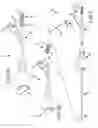 Fig. 03 - Methods of fusing a sacroiliac joint with a fluted screw delivered across the sacroiliac joint