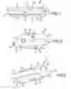 Fig. 05 - Methods of fusing a sacroiliac joint with a fluted screw delivered across the sacroiliac joint