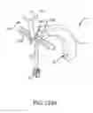 Fig. 147 - Methods of fusing a sacroiliac joint with a fluted screw delivered across the sacroiliac joint