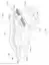 Fig. 210 - Methods of fusing a sacroiliac joint with a fluted screw delivered across the sacroiliac joint
